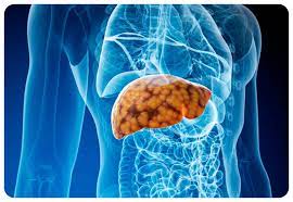 Цироз печінки: що це за хвороба і як вчасно її розпізнати