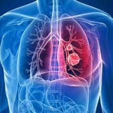 ЩО ВАЖЛИВО ЗНАТИ ПРО РАК ЛЕГЕНЬ