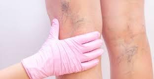 Тромбофлебіт