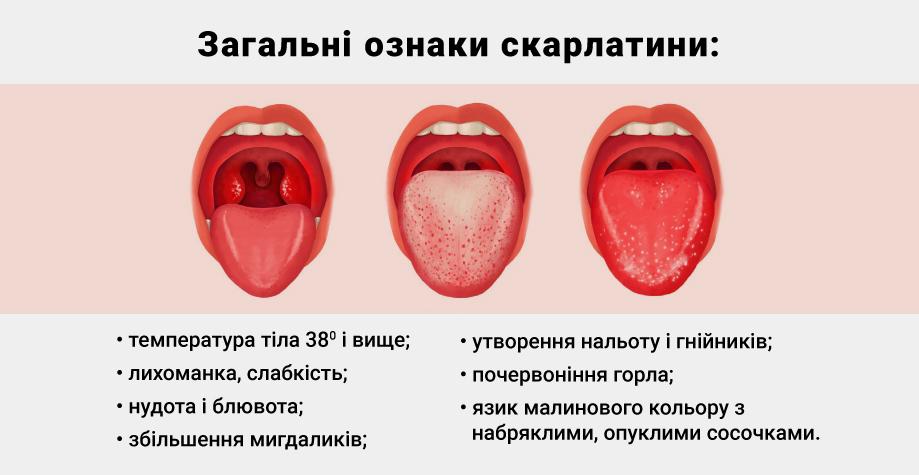 Скарлатина